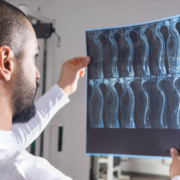 Spinal Injuries - What You Need to Know